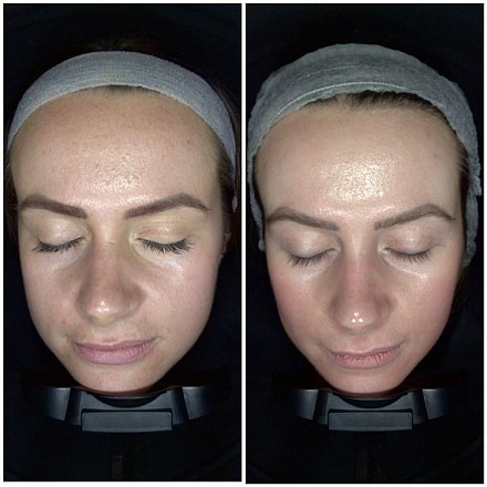 Cosmelan Peel