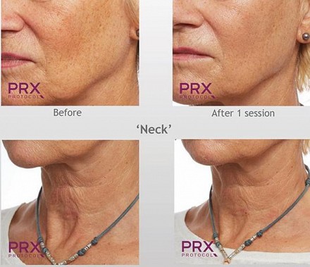 PRX - T33 Peeling